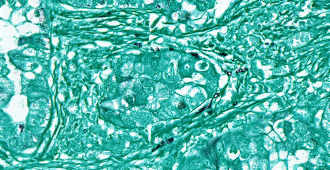 一种不常见的真菌(黑色)，存在于人类肺癌组织(蓝绿色)中，但不在细胞内。图片来源:Lian Narunsky Haziza和Nancy Gavert